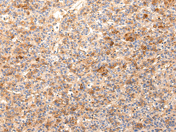 Immunohistochemistry of paraffin-embedded Human liver cancer using ZNF365 Polyclonal Antibody at dilution of  1/20