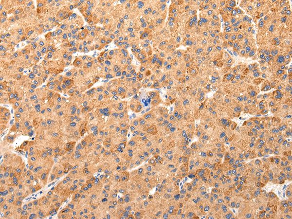 Immunohistochemistry of paraffin-embedded Human liver cancer tissue using AQP7 Polyclonal Antibody at dilution 1:40