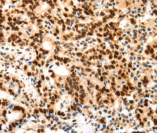 Immunohistochemistry of paraffin-embedded Human gastic cancer using Proliferating Cell Nuclear Antigen Polyclonal Antibody at dilution of 1:44