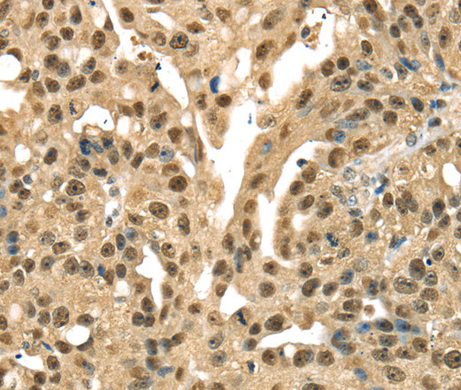 Immunohistochemistry of paraffin-embedded Human esophagus cancer tissue using DFFA Polyclonal Antibody at dilution 1:40