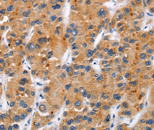 Immunohistochemistry of paraffin-embedded Human liver cancer tissue using CD137 Polyclonal Antibody at dilution 1:50