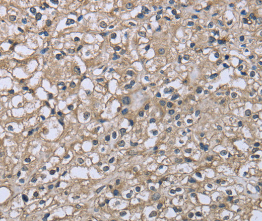 Immunohistochemistry of paraffin-embedded Human prostate cancer using CD32 Polyclonal Antibody at dilution of 1:40