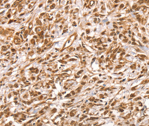 Immunohistochemistry of paraffin-embedded Human colon cancer using SUMO2/3/4 Polyclonal Antibody at dilution of 1:100