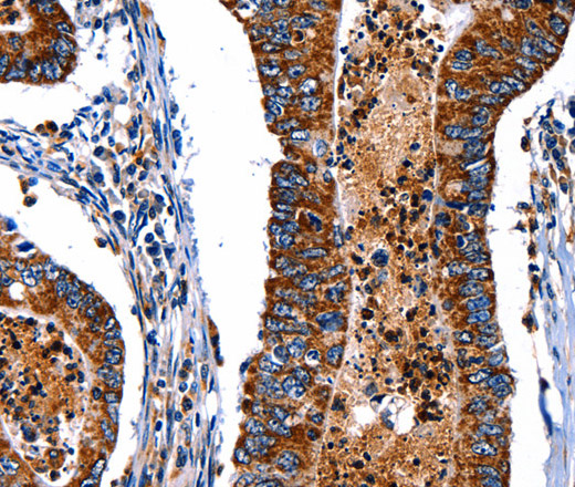 Immunohistochemistry of paraffin-embedded Human colon cancer tissue using ITGA7 Polyclonal Antibody at dilution 1:35