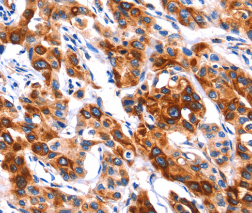 Immunohistochemistry of paraffin-embedded Human lung cancer tissue using SEPT4 Polyclonal Antibody at dilution 1:50