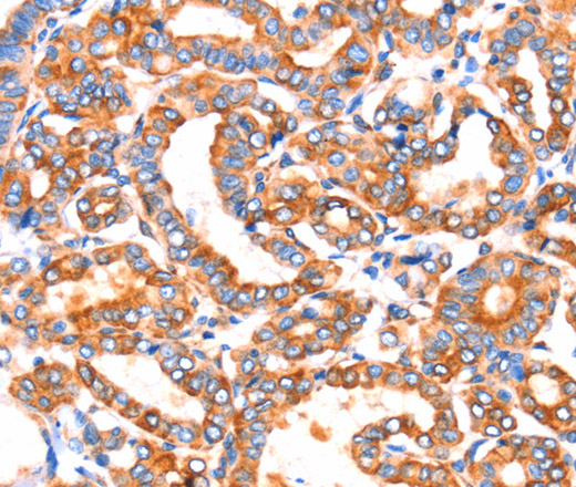 Immunohistochemistry of paraffin-embedded Human thyroid cancer tissue using SEPT4 Polyclonal Antibody at dilution 1:50
