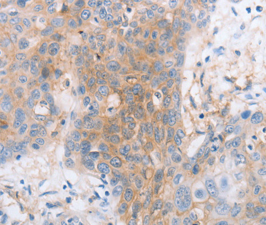 Immunohistochemistry of paraffin-embedded Human esophagus cancer tissue using CD85d Polyclonal Antibody at dilution 1:30