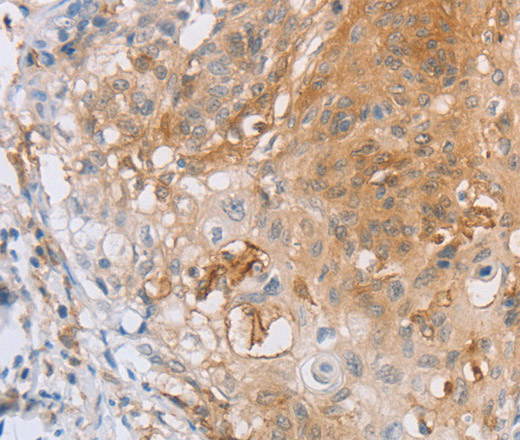 Immunohistochemistry of paraffin-embedded Human cervical cancer tissue using CD85d Polyclonal Antibody at dilution 1:30