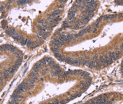 Immunohistochemistry of paraffin-embedded Human colon cancer using SEPT7 Polyclonal Antibody at dilution of 1:60
