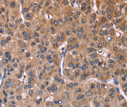 Immunohistochemistry of paraffin-embedded Human liver cancer using SEPT7 Polyclonal Antibody at dilution of 1:60