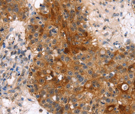 Immunohistochemistry of paraffin-embedded Human breast cancer tissue using FGFR3 Polyclonal Antibody at dilution 1:35
