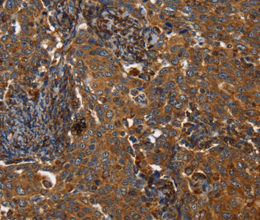 Immunohistochemistry of paraffin-embedded Human liver cancer using TPM2 Polyclonal Antibody at dilution of 1:35