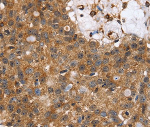 Immunohistochemistry of paraffin-embedded Human lung cancer using TPM2 Polyclonal Antibody at dilution of 1:35