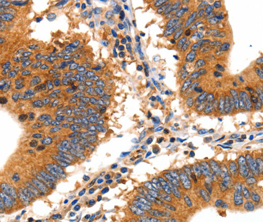Immunohistochemistry of paraffin-embedded Human colon cancer tissue using SLC2A2 Polyclonal Antibody at dilution 1:30