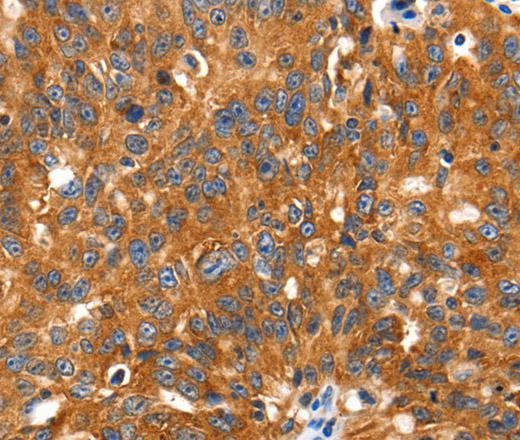 Immunohistochemistry of paraffin-embedded Human ovarian cancer tissue using SLC2A2 Polyclonal Antibody at dilution 1:30