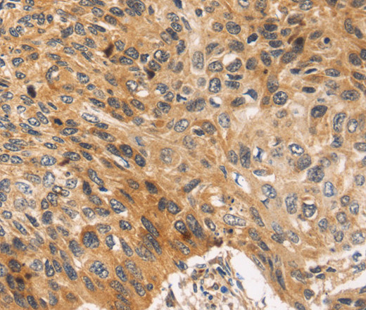 Immunohistochemistry of paraffin-embedded Human esophagus cancer using JNK2 Polyclonal Antibody at dilution of 1:30