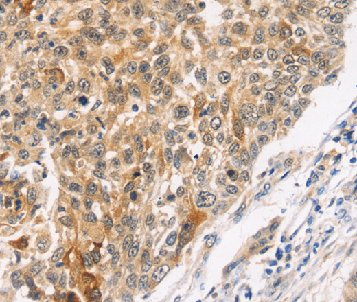 Immunohistochemistry of paraffin-embedded Human lung cancer using JNK2 Polyclonal Antibody at dilution of 1:30