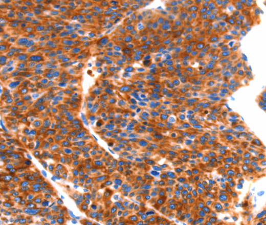 Immunohistochemistry of paraffin-embedded Human liver cancer tissue using SEPT4 Polyclonal Antibody at dilution 1:50