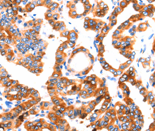 Immunohistochemistry of paraffin-embedded Human thyroid cancer tissue using SEPT4 Polyclonal Antibody at dilution 1:50