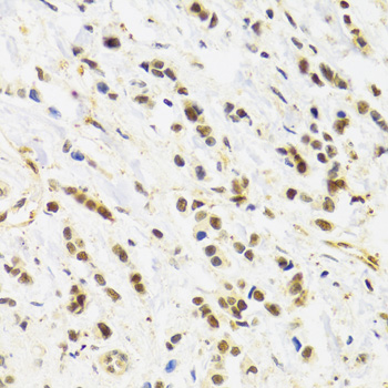 Immunohistochemistry of paraffin-embedded Human breast cancer using RAD50 Polyclonal Antibody at dilution of  1:100 (40x lens).