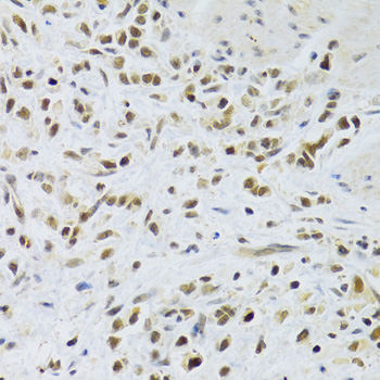 Immunohistochemistry of paraffin-embedded Human gastric cancer using RAD50 Polyclonal Antibody at dilution of  1:100 (40x lens).