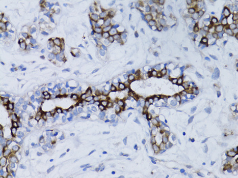 Immunohistochemistry of paraffin-embedded Human breast cancer using BRCA1 Polyclonal Antibody at dilution of  1:100 (40x lens).