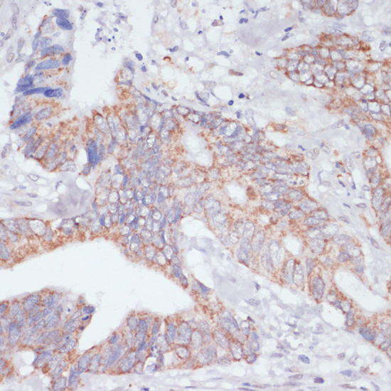 Immunohistochemistry of paraffin-embedded Human colon carcinoma using IKBKE Polyclonal Antibody at dilution of  1:200 (40x lens).
