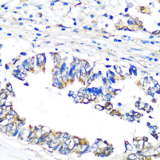 Immunohistochemistry of paraffin-embedded Human colon carcinoma using PBEF / NAMPT Polyclonal Antibody at dilution of  1:100 (40x lens).