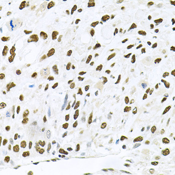 Immunohistochemistry of paraffin-embedded Human lung cancer using JNK1 Polyclonal Antibody at dilution of  1:100 (40x lens).