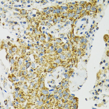 Immunohistochemistry of paraffin-embedded Human lung cancer using HSPA9 Polyclonal Antibody at dilution of  1:100 (40x lens).