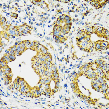 Immunohistochemistry of paraffin-embedded Human gastric cancer using HSPA9 Polyclonal Antibody at dilution of  1:100 (40x lens).