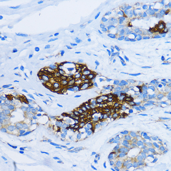 Immunohistochemistry of paraffin-embedded Human mammary cancer using EEA1 Polyclonal Antibody at dilution of  1:100 (40x lens).