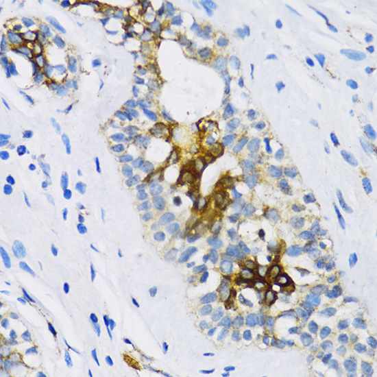 Immunohistochemistry of paraffin-embedded Human breast using PTCH1 Polyclonal Antibody at dilution of  1:100 (40x lens).