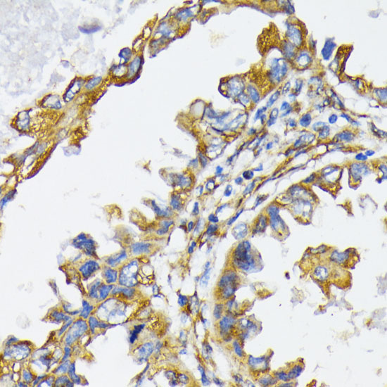 Immunohistochemistry of paraffin-embedded Human lung cancer using HSP90B1 Polyclonal Antibody at dilution of  1:200 (40x lens).