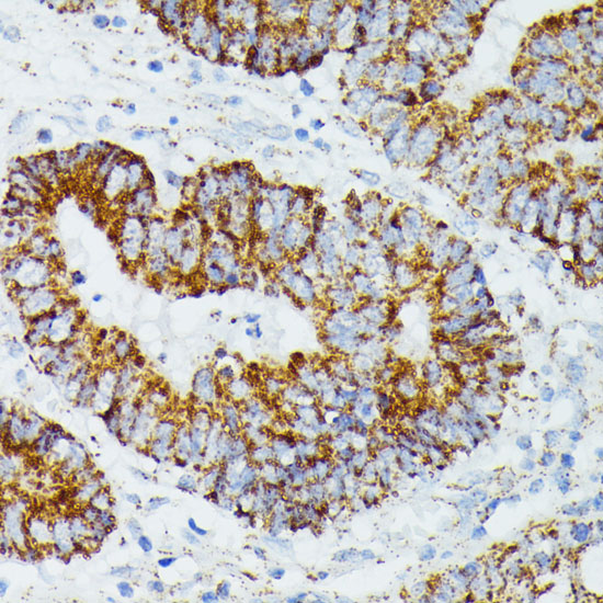 Immunohistochemistry of paraffin-embedded Human colon carcinoma using ETHE1 Polyclonal Antibody at dilution of  1:100 (40x lens).