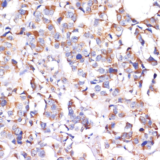 Immunohistochemistry of paraffin-embedded Human breast cancer using STOML2 Polyclonal Antibody at dilution of  1:100 (40x lens).