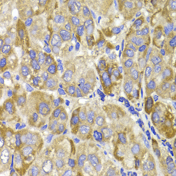 Immunohistochemistry of paraffin-embedded Human liver cancer using MAGED1 Polyclonal Antibody at dilution of  1:100 (40x lens).