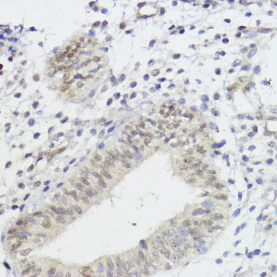 Immunohistochemistry of paraffin-embedded Human uterine cancer using AKT Polyclonal Antibody at dilution of  1:100 (40x lens).