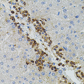 Immunohistochemistry of paraffin-embedded Human liver damage using MMP9 Polyclonal Antibody at dilution of  1:100 (40x lens).