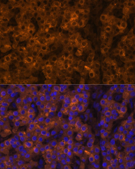 Immunofluorescence analysis of Human liver cancer using TTR Polyclonal Antibody at dilution of  1:100 (40x lens). Blue: DAPI for nuclear staining.