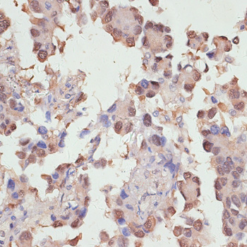 Immunohistochemistry of paraffin-embedded Human lung cancer using YAP1 Polyclonal Antibody at dilution of  1:100 (40x lens).