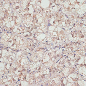 Immunohistochemistry of paraffin-embedded Human liver cancer using YAP1 Polyclonal Antibody at dilution of  1:100 (40x lens).