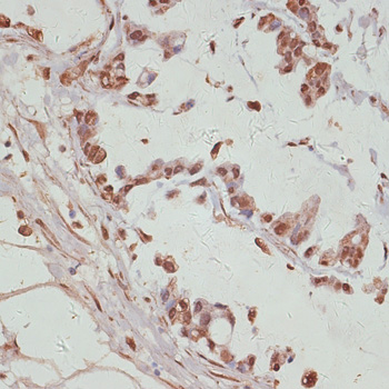 Immunohistochemistry of paraffin-embedded Human gastric cancer using YAP1 Polyclonal Antibody at dilution of  1:100 (40x lens).