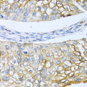 Immunohistochemistry of paraffin-embedded Human prostate cancer using BMP4 Polyclonal Antibody at dilution of  1:100 (40x lens).