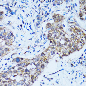 Immunohistochemistry of paraffin-embedded Human lung cancer using Caspase-3 Polyclonal Antibody at dilution of  1:100 (40x lens).