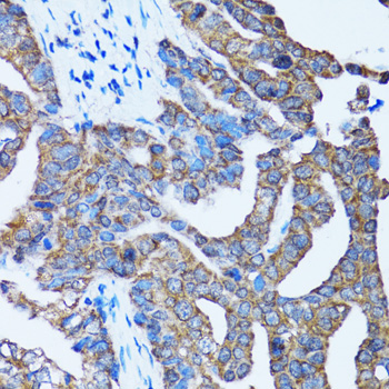 Immunohistochemistry of paraffin-embedded Human gastric cancer using Caspase-3 Polyclonal Antibody at dilution of  1:100 (40x lens).