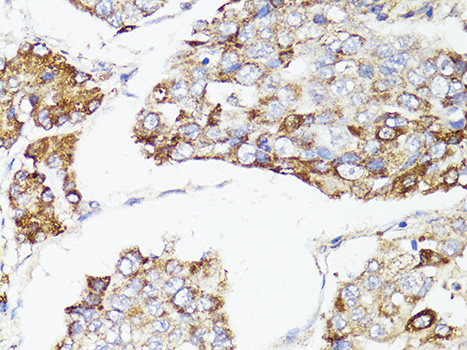 Immunohistochemistry of paraffin-embedded Human liver cancer using mTOR Polyclonal Antibody at dilution of  1:150 (40x lens).