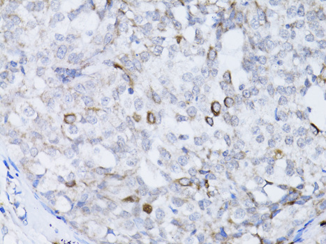 Immunohistochemistry of paraffin-embedded Human breast cancer using BRCA1 Polyclonal Antibody at dilution of  1:100 (40x lens).