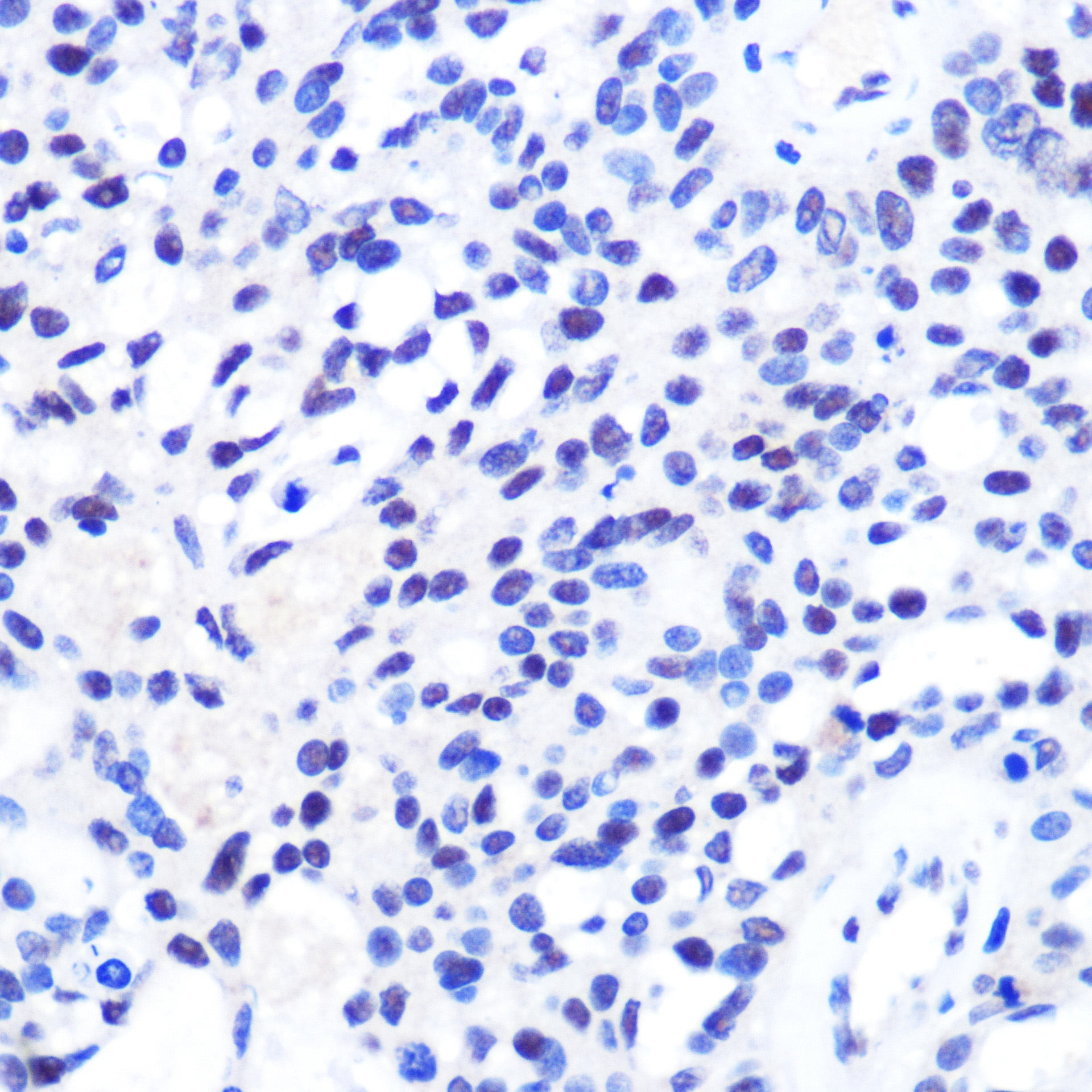 Immunohistochemistry of paraffin-embedded Human oophoroma using CHD4 Polyclonal Antibody at dilution of  1:100 (40x lens).