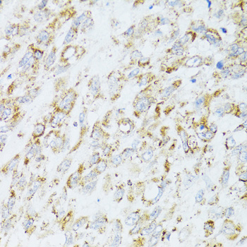 Immunohistochemistry of paraffin-embedded Human lung cancer using EGFR Polyclonal Antibody at dilution of  1:100 (40x lens).
